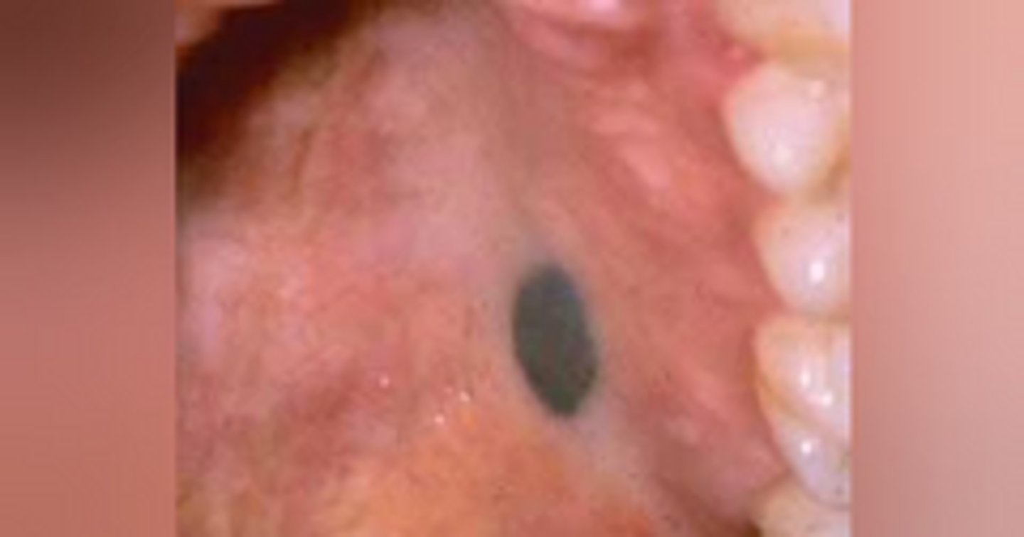 <p>A patient presents with a small, well-circumscribed blue-gray lesion on the palate. The lesion has been present for years with no change in size or color.</p><p>What is the most likely diagnosis?</p>