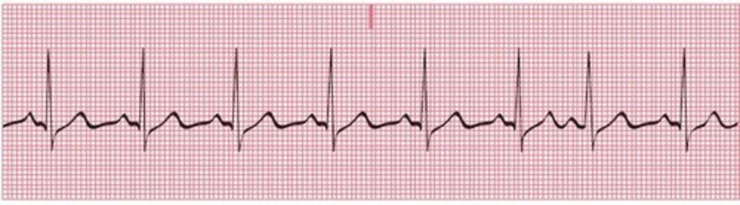 <p>Which of the following occurs in the tracing?</p><p>A) fusion beat</p><p>B) premature junctional complexes</p><p>C) premature ventricular complexes</p><p>D) premature atrial complexes</p>