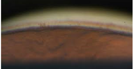 <p>what is the most posterior structure shown &amp; what is the grade? </p>