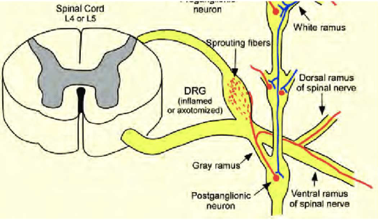 <ul><li><p><span>Sympathetic fibers form a basket weave around the DRG</span></p><ul><li><p><span>Releases adrenaline → triggers action potentials fires bi- directionally</span></p></li></ul></li><li><p><span>Antidromically → target tissues → release of substance P, histamine → redness, swelling, spreading pain → peripheral sensitization</span></p></li><li><p><span>Orthodromically → CNS → central sensitization</span></p></li></ul><p></p>