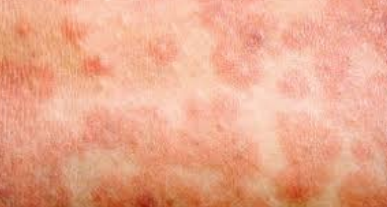 <p>The following patient comes with these symptoms. What could they have?</p><p> Fever  Rash  Cough  Runny nose  Sore throat</p>