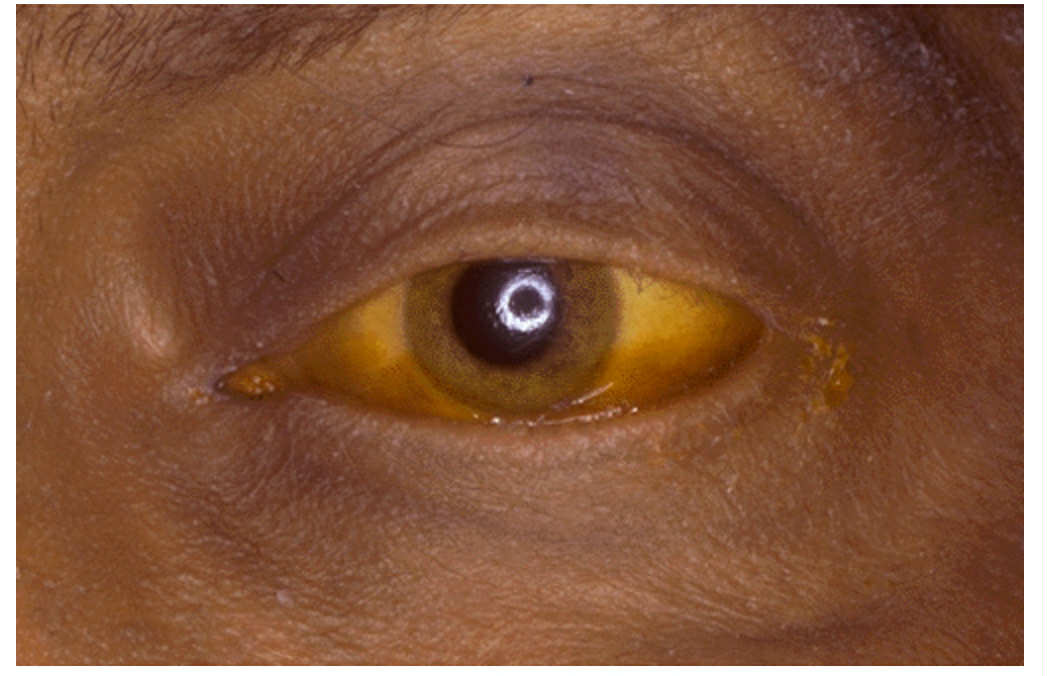 <p>Sclera of the eye is yellow because the patient has _____ or ______. What laboratory test finding is most likely present?</p>