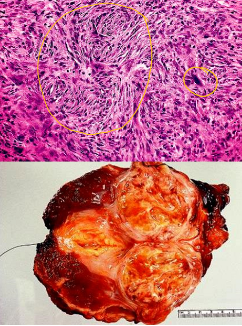 <p><strong>undifferentiated pleomorphic sarcoma (UPS)</strong>; most common <strong><span style="color: red">adult sarcoma</span></strong> that may <strong><span style="color: red">invade bone &amp; is osteolytic</span></strong></p><ul><li><p><strong><mark data-color="blue">storiform-pleomorphic type</mark></strong> is the most common - <strong><mark data-color="blue">sheets of large anaplastic spindled to polygonal cells with hyperchromatic irregular, sometimes bizarre nuclei</mark></strong></p></li><li><p>treated with <strong><mark data-color="purple">surgery &amp; adjuvant chemotherapy, and/or radiation</mark></strong></p></li><li><p>most are <strong><mark data-color="blue">aneuploid &amp; prognosis is generally poor </mark></strong></p></li></ul>