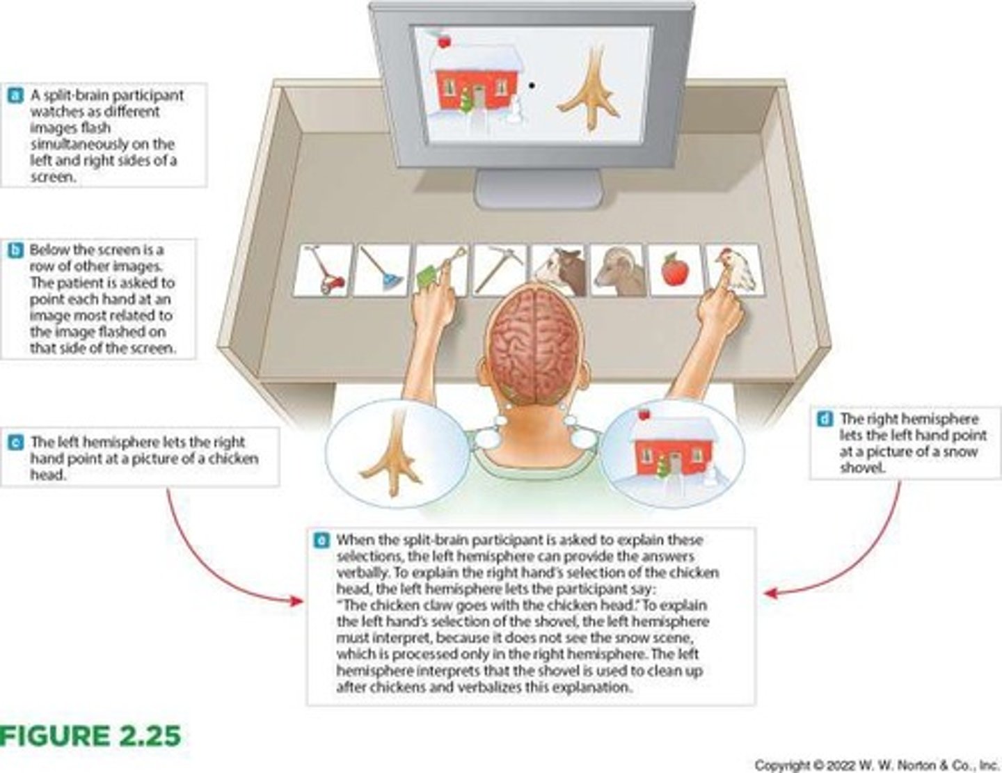 <p>A condition in which the corpus callosum is surgically severed, preventing direct information transfer between the two hemispheres.</p>