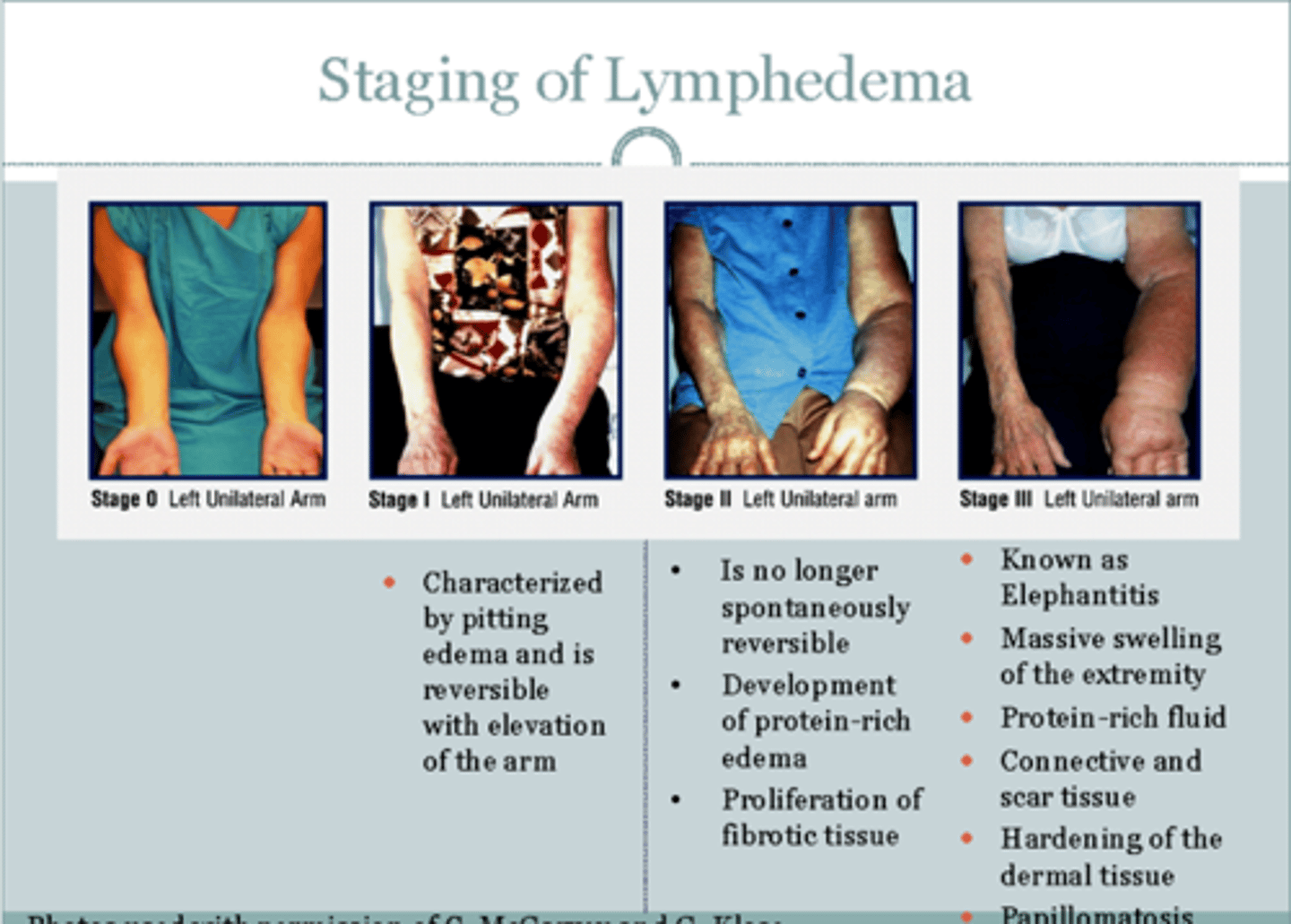 <p>B. CORRECT. Following removal of lymph tissue, lymphedema can cause tissue in the affected extremity to swell with fluid due to inhibited reabsorption by the lymphatic system.</p><p>A. Palpable nodules in the unaffected breast are not a</p><p>a manifestation of lymphedema. Nodules in breast tissue can be an indication of fibrocystic breast disease.</p><p>C. Scaly patches are not a manifestation of lymphedema. Thick, silvery scales on the</p><p>skin are an indication of psoriasis.</p><p>D. Migraine headaches are not a manifestation of lymphedema. Causes of migraine headaches vary, but manifestations include photophobia, nausea, vomiting, and visual disturbances.</p>