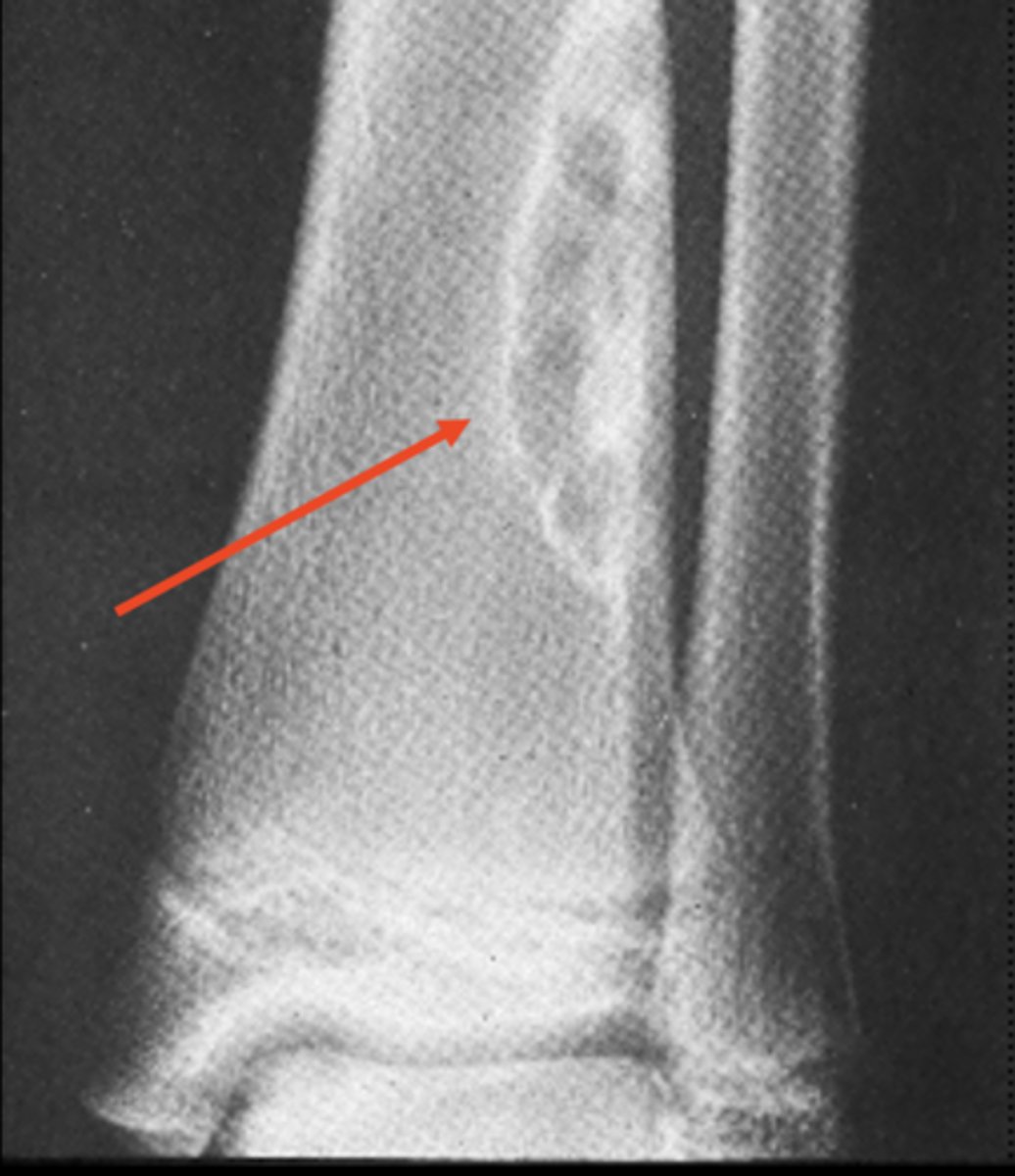 <p>State the radiographic features of non-ossifying fibroma</p>