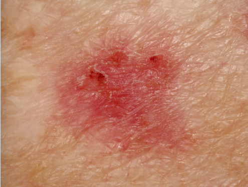 <p>What is basal cell carcinoma?</p>