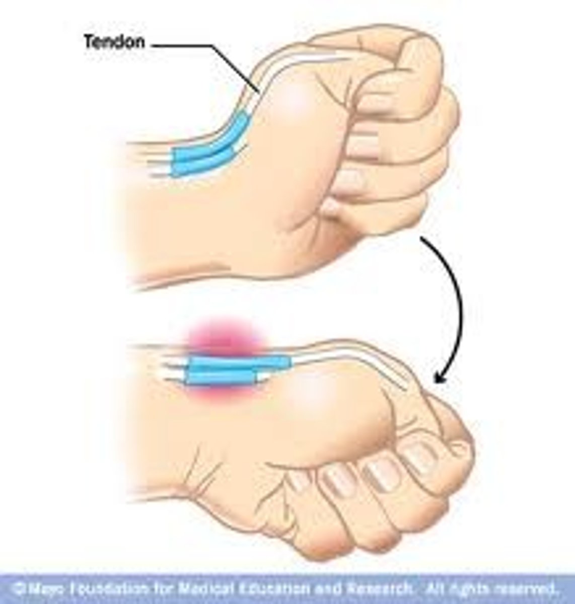 <p>stretching or lengthening of the thumb tendon to assess the possibility of de Quervain's disease, or tenosynovitis of the thumb tendon</p>