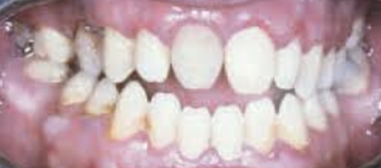 <p>Er kan ook een afwijkingen zitten in de vorm van het element, dit kan komen door een groeistoornis tijdens het groeien van de tandkiem. Dit kan gebeuren als de moeder lues (syfilis) heeft gehad. Het kind kan dan <span><strong><span>Hutchinson incisieven</span></strong><span> </span></span>krijgen. Hierbij missen alleen de centrale incisieven de middelste knobbel aan de snijrand waardoor het element smaller wordt.</p>