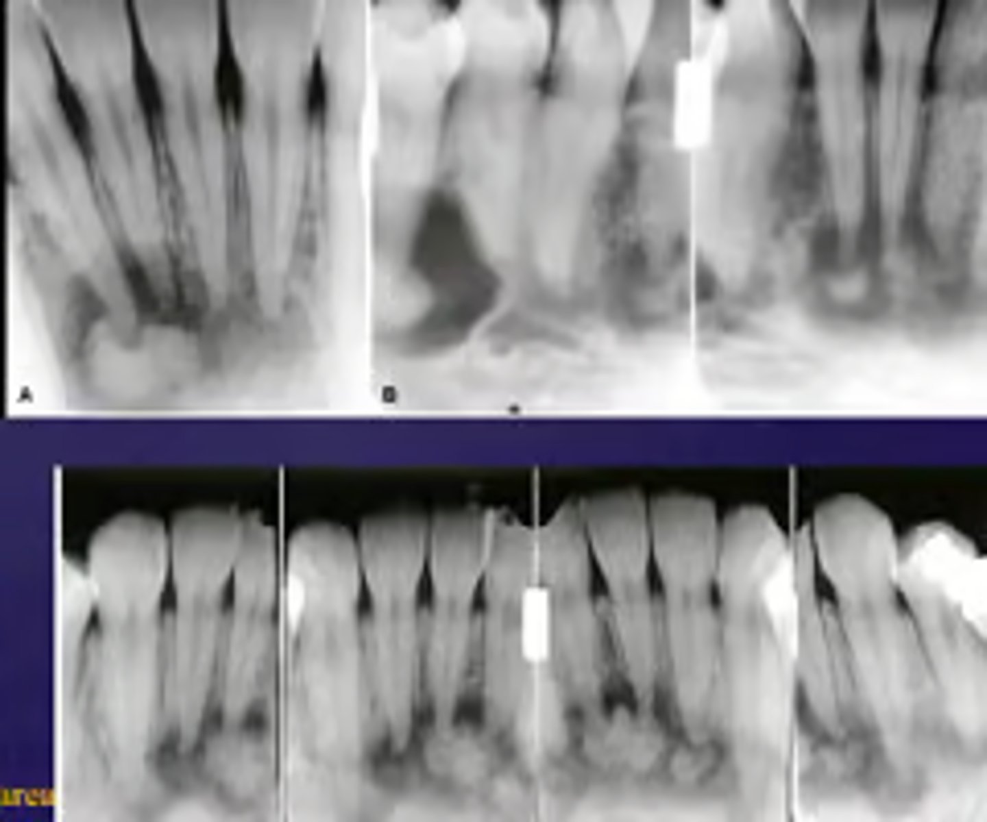<p>ID the lesion:radiopacity in center of radiolucent area</p>