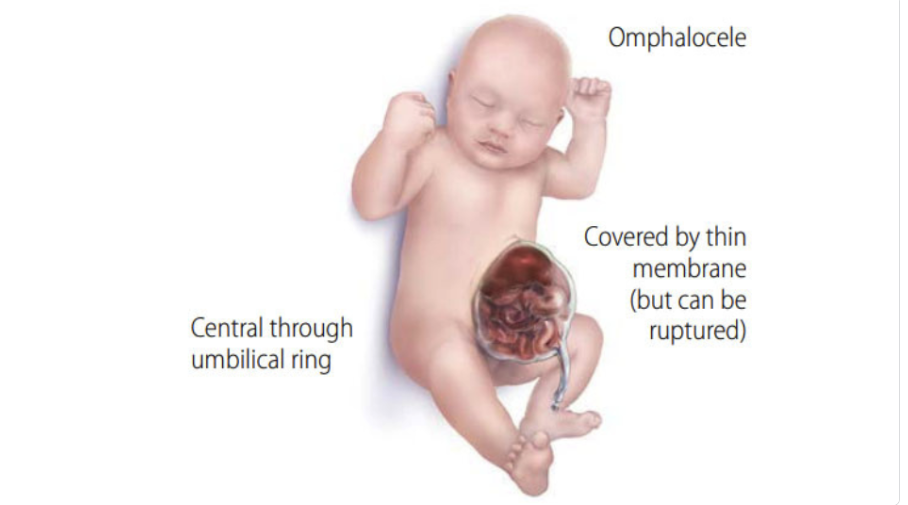 <p><span>o <strong>Omphalocele<br></strong></span></p><p><span>Results from the failure of the intestinal loop to return inside the abdominal cavity<br></span></p>