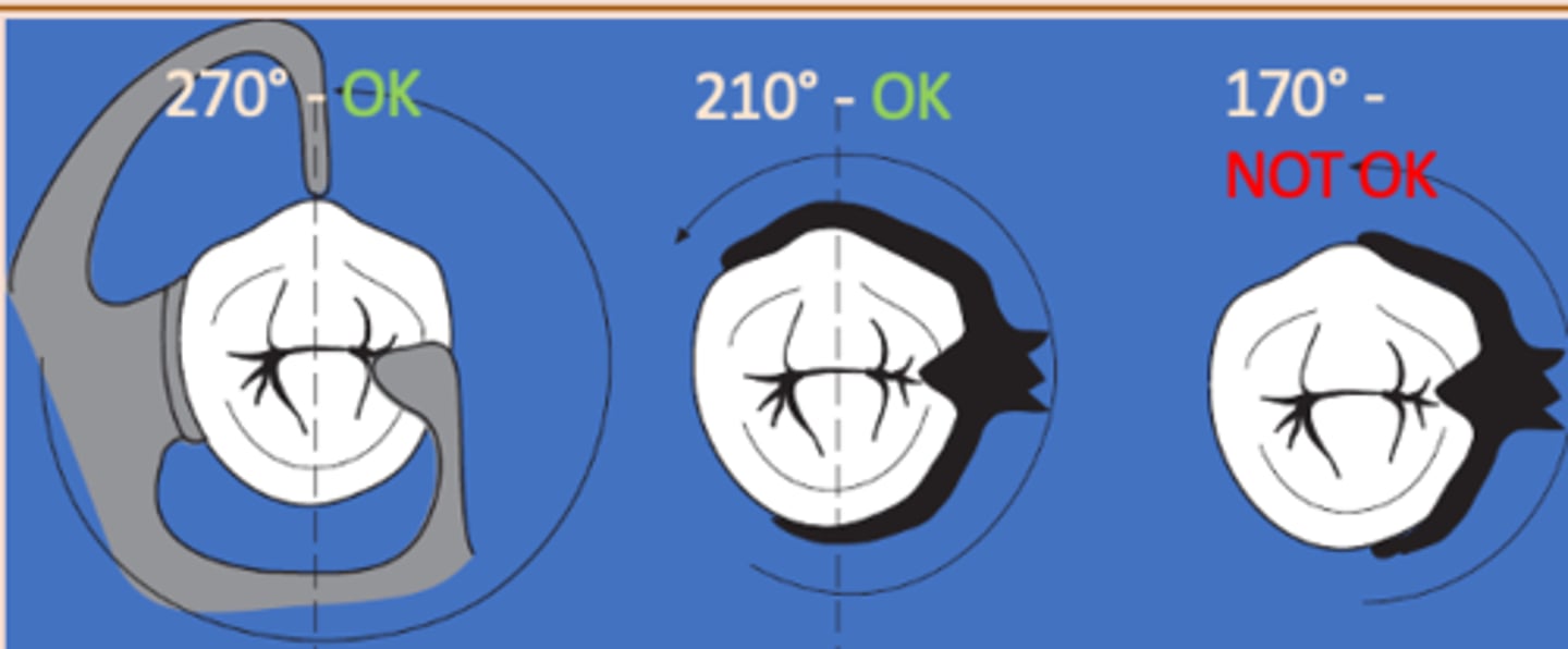 <p>Clasp Assembly six requirements: </p><p>5) Clasp assembly must engage more than 180 degrees of the tooth to prevent migration of the tooth out of the clasp assembly</p>