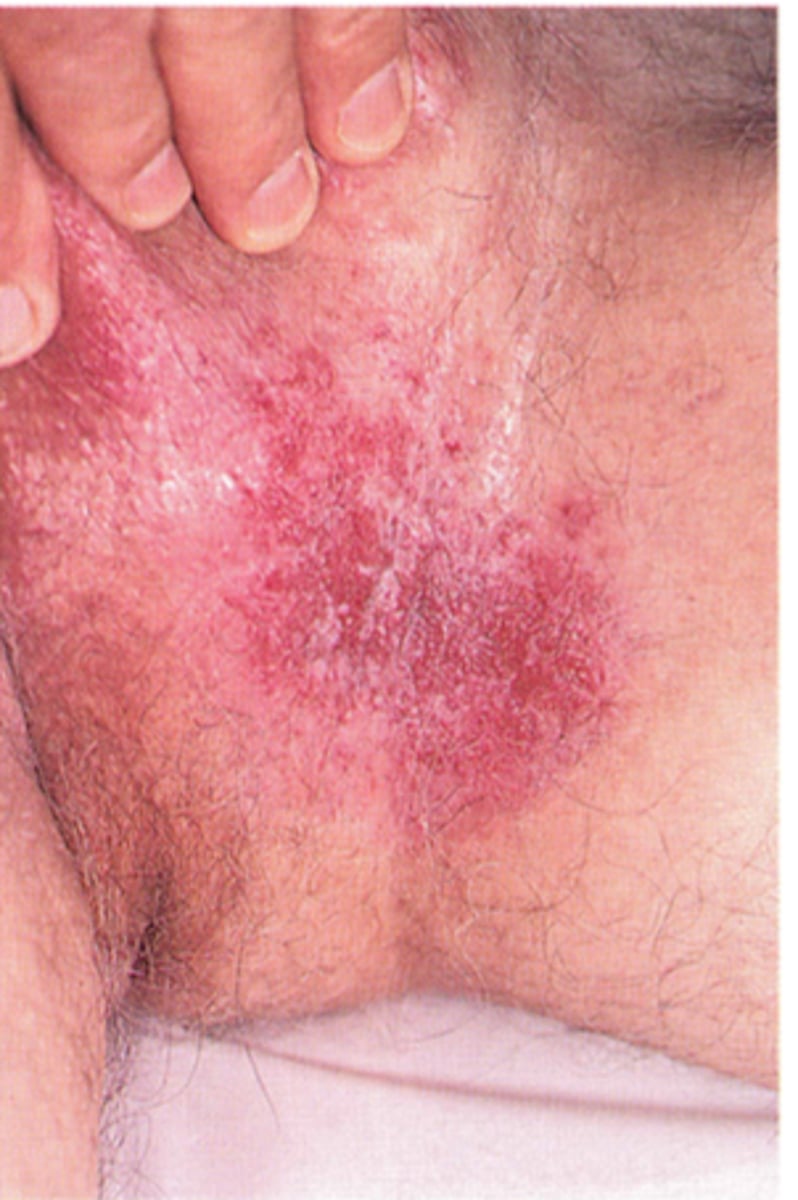 <p>Paget Disease</p>