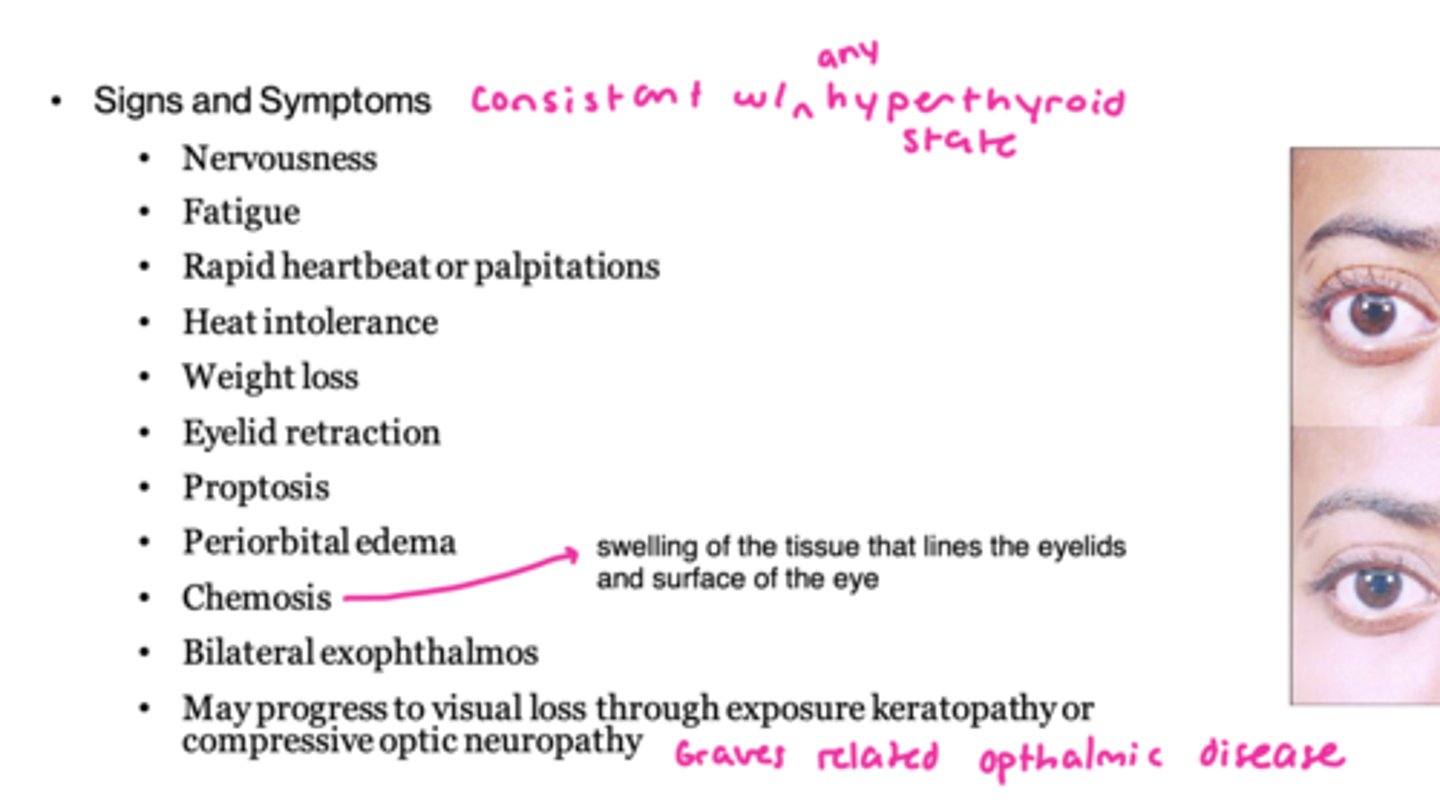 <p>Graves disease (consistent with hyperthyroidism)</p>