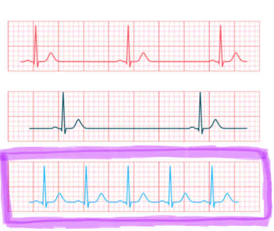 <p><span>the heart is pumping too fast</span></p><ul><li><p><span>a heart rate of 100 to 150 BPM</span></p></li></ul><p></p>