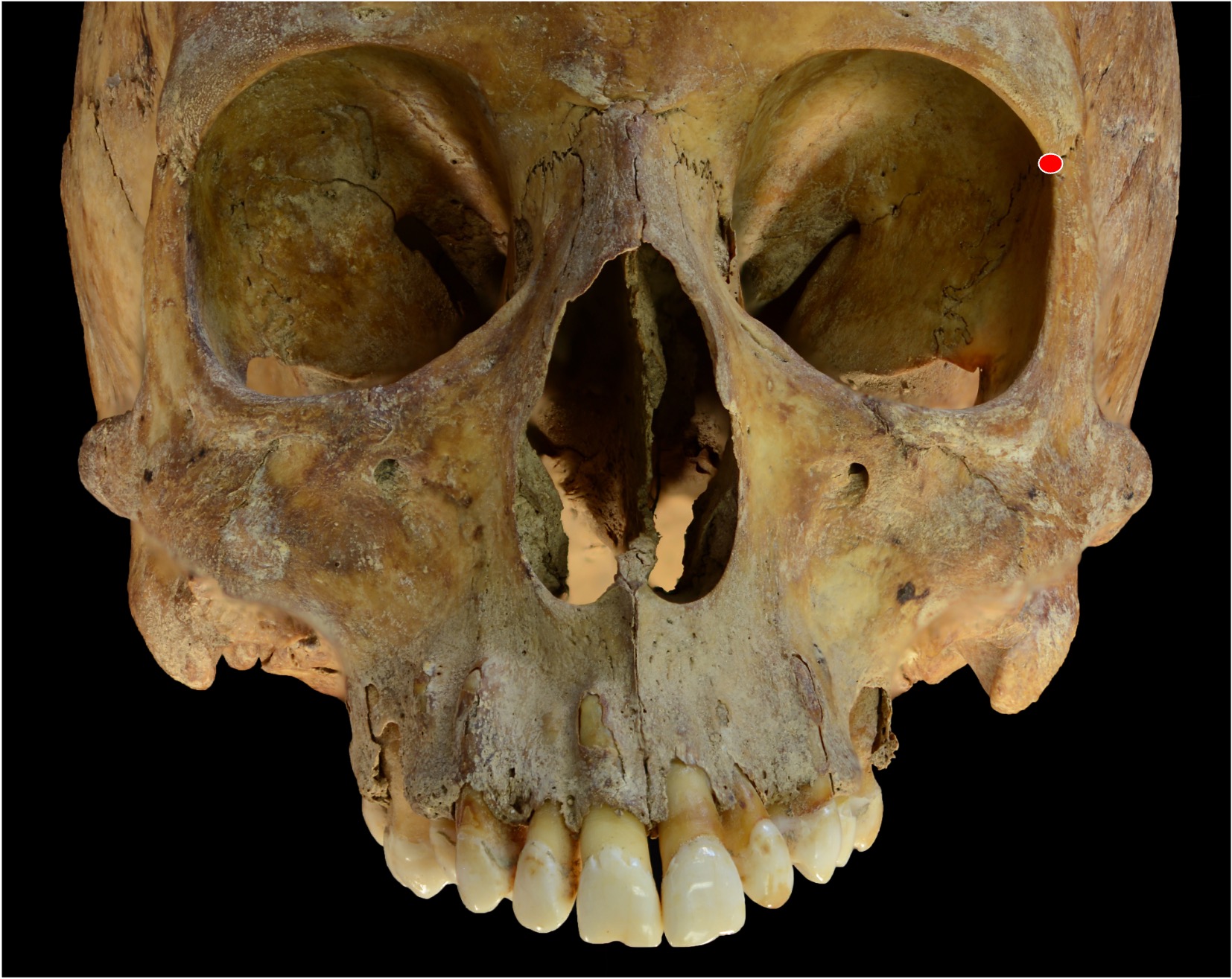 <p>Point where frontozygomatic suture crosses inner orbital rim</p>