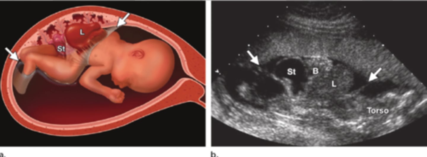 <p>The most severe form of limb-body wall complex, where organs are outside the body and attached directly to the placenta.</p>