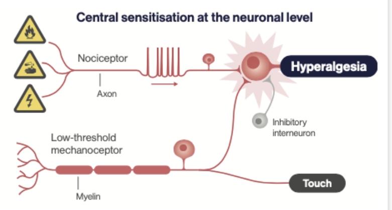 <ul><li><p>infection activates the immune system (IL-1, IL-6, TNF-a)</p></li><li><p>these stimulate PGE2 in tissues and brain</p></li><li><p><strong>primary hyperalgesia</strong>: due to peripheral sensitisation by PGE2 when pain threshold of nociceptors is lowered</p></li><li><p><strong>secondary hyperalgesia</strong>: due to central sensitisation (as pictured) in the spinal cord and brain</p></li></ul><p></p>
