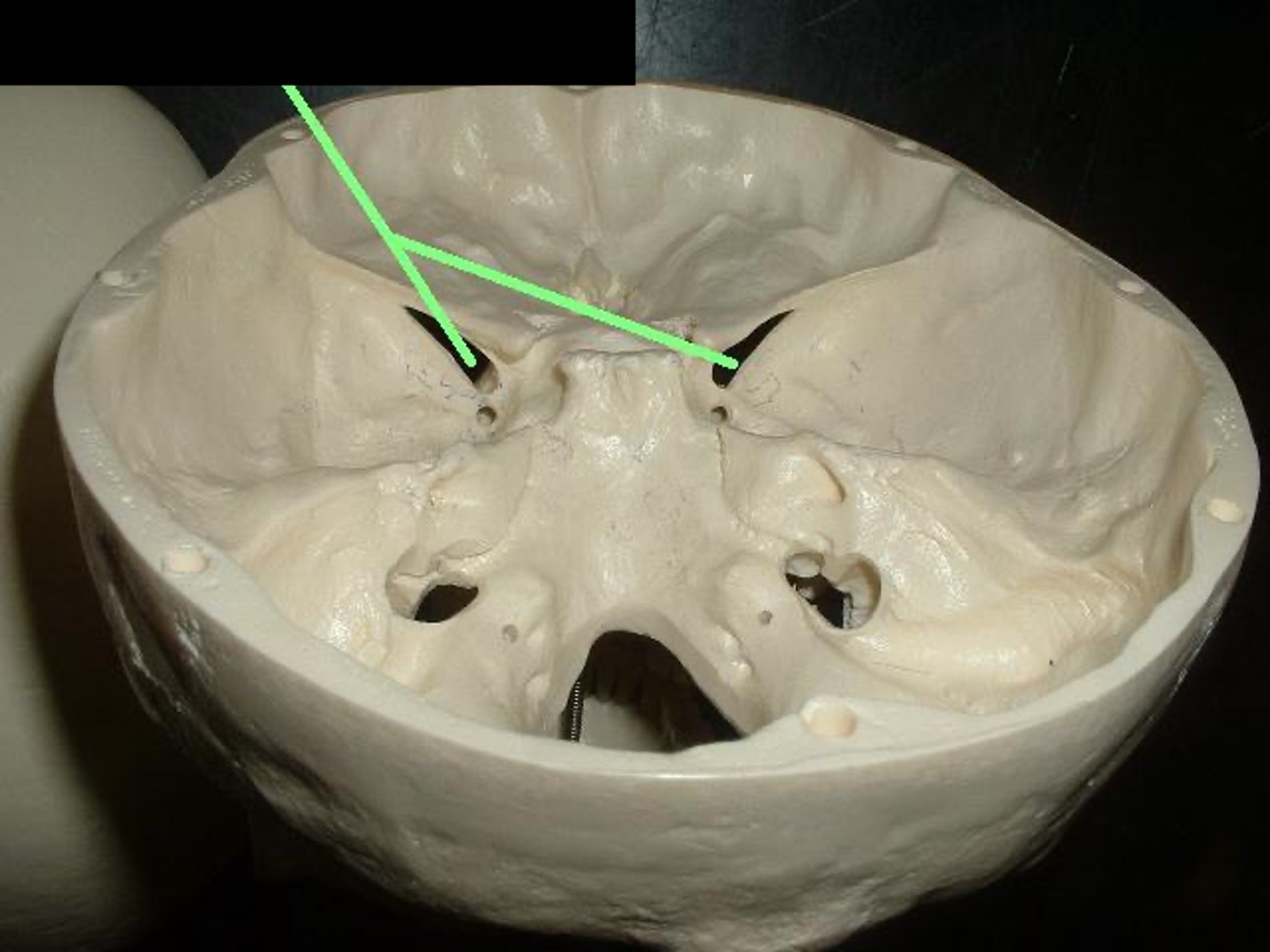 <p>the crack beside the optic foramen</p>