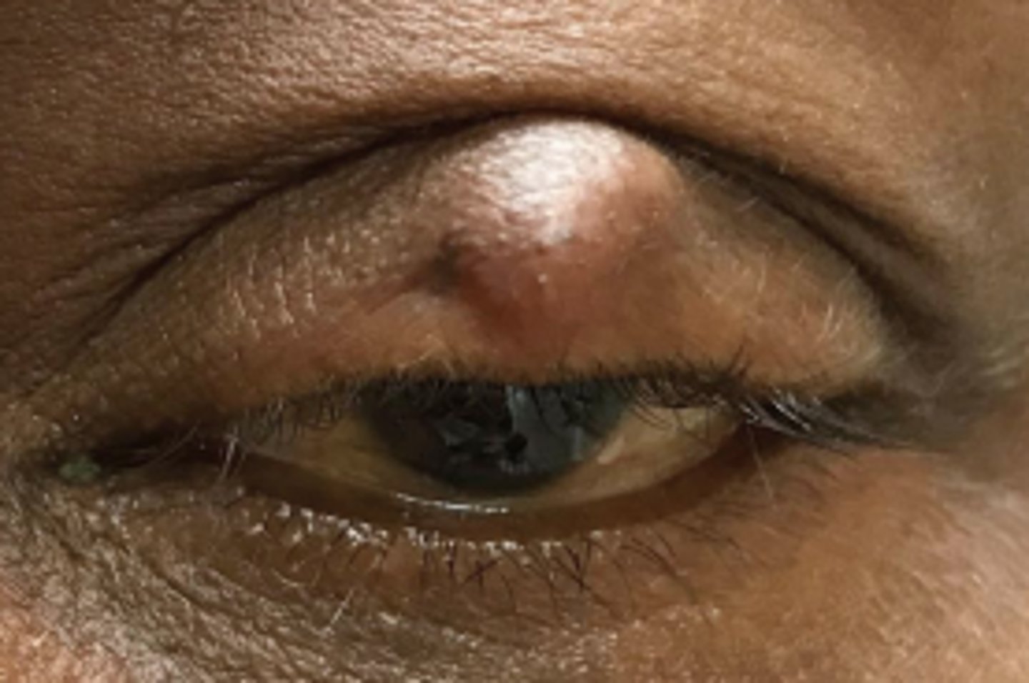 <p>obstruction and inflammation of a sebaceous gland = lipogranuloma, either...</p><p>anterior = Zeis Gland (sebaceous cyst) </p><p>interior = Meibomian gland</p>