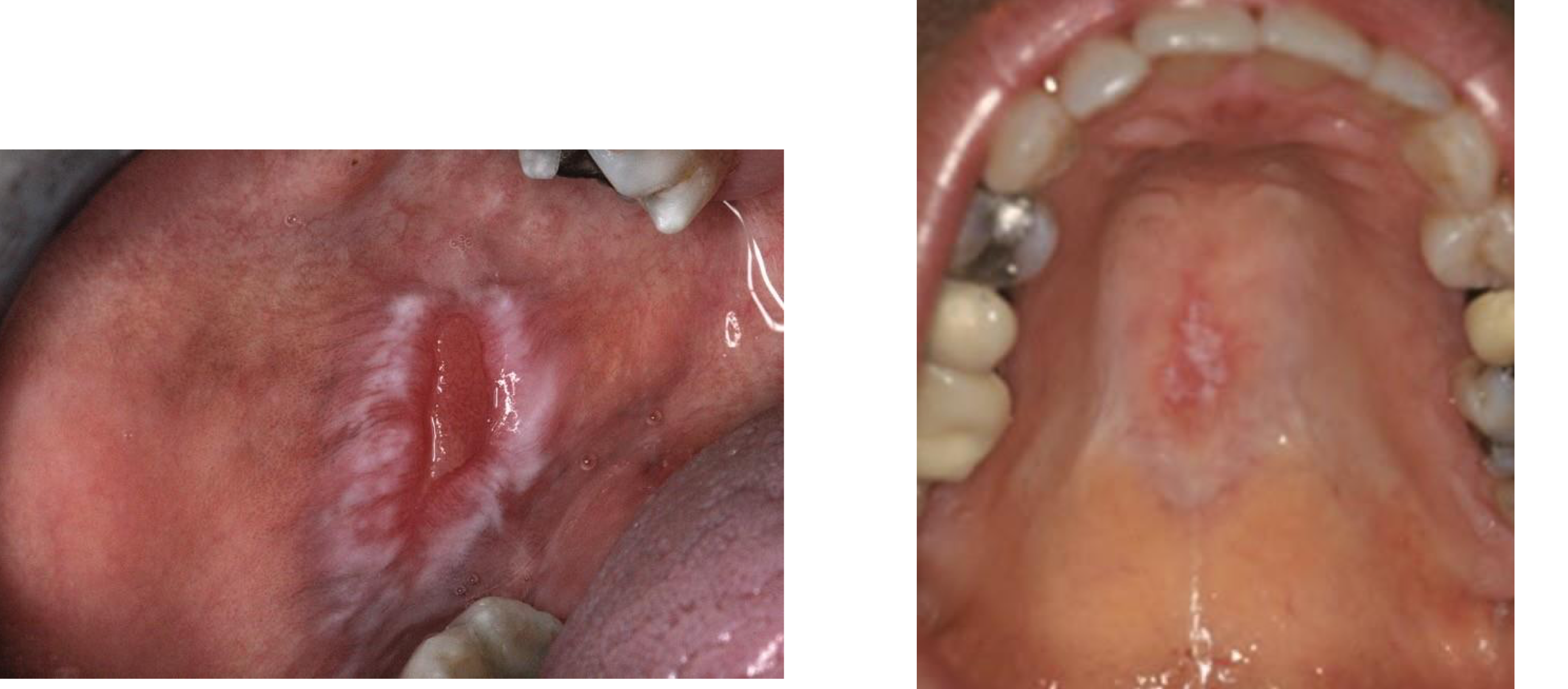 <p>which autoimmune/immune-mediated/allergic lesion: ulcer w raised border, erythema and striations surround it</p>