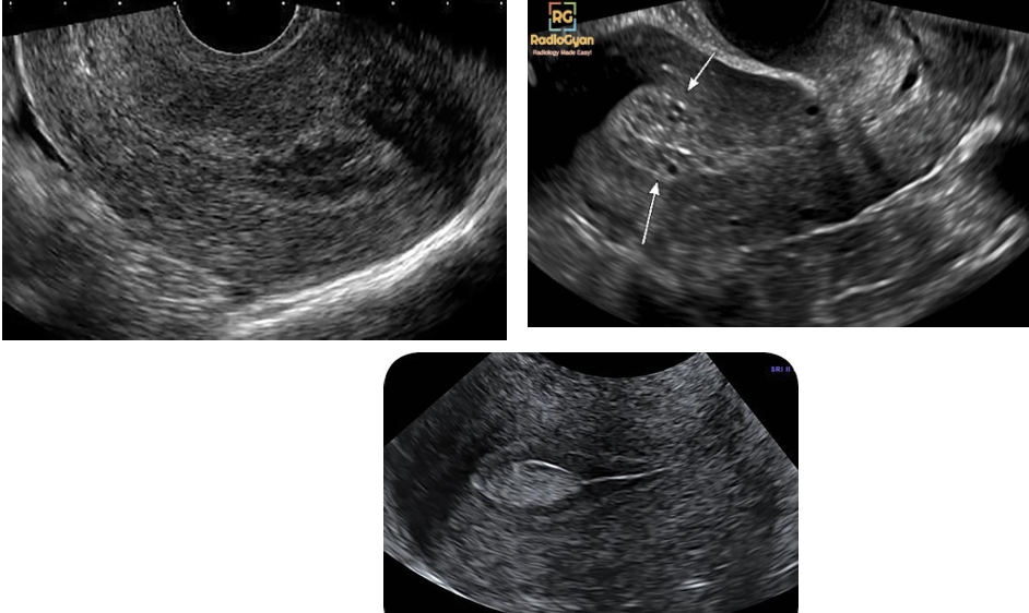 <p>Endometritis</p>