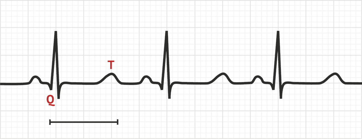 <p>d) prolonged QT interval</p><p>e) prolonged ST segment</p>