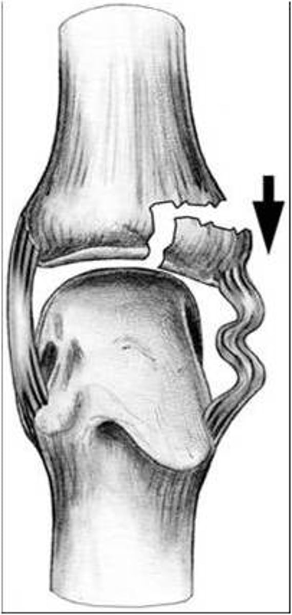<p># with involvement of articular surface</p>
