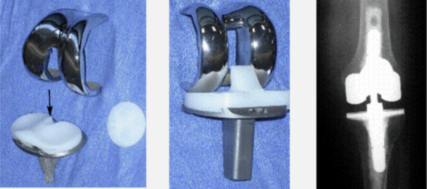 <p>- cruciate-retaining</p><p>- cruciate - substituting</p><p>- hinged</p><p>- fixed bearing</p><p>- mobile bearing</p>