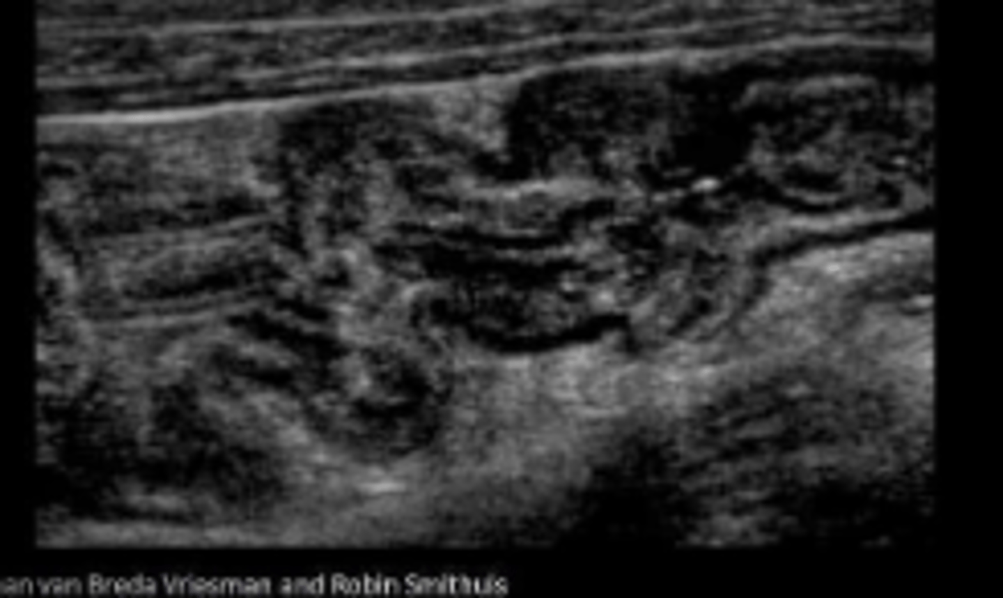 <p>Colitis</p>
