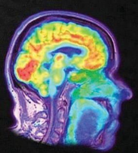 <ul><li><p>a visual display of brain activity that detects where a radioactive form of glucose goes while the brain performs a given task</p></li></ul><p></p>