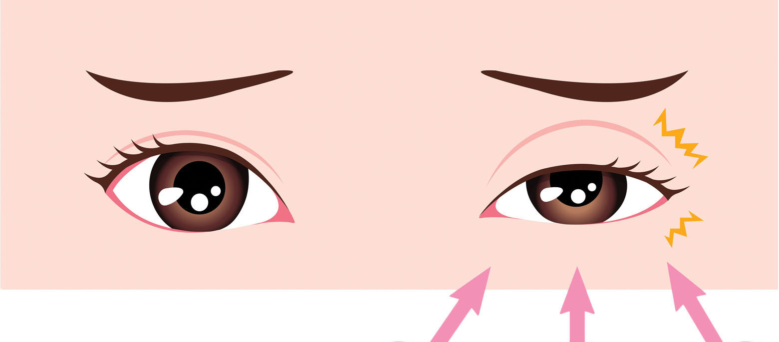 <p><em>= an involuntary spasm of the eyelid, often due to stress or fatigue</em></p><p></p><ul><li><p>When I’m stressed, m_ e__ t_______ all day.</p></li><li><p>I’ve had too much coffee and now m_ e__ t_______.</p></li></ul><p></p>