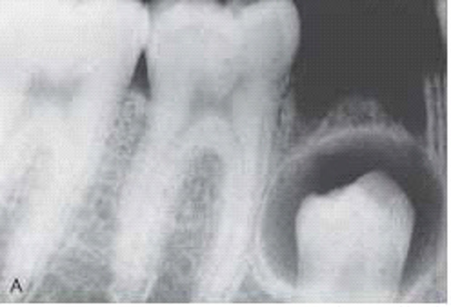 <p>dentigerous cyst.</p><p>A dentigerous cyst is a well-defined unilocular radiolucency around the crown of an unerupted tooth. A normal developmental sac has a much smaller radiolucency around the crown. A primordial cyst develops in place of a tooth. The lateral periodontal cyst is most often seen in the mandibular cuspid and premolar region.</p>