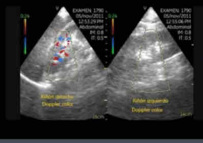 <p>What does the following describe?</p><p><span>• Obstruction of blood supply or drainage</span><br><span>• Hypertension; lower extremity pulses absent</span><br><span>• Elevated LDH, hematuria</span><br><span>• Depending on the time frame following occlusion, renal parenchyma appears normal,</span><br><span>hypoechoic, or hyperechoic</span></p>