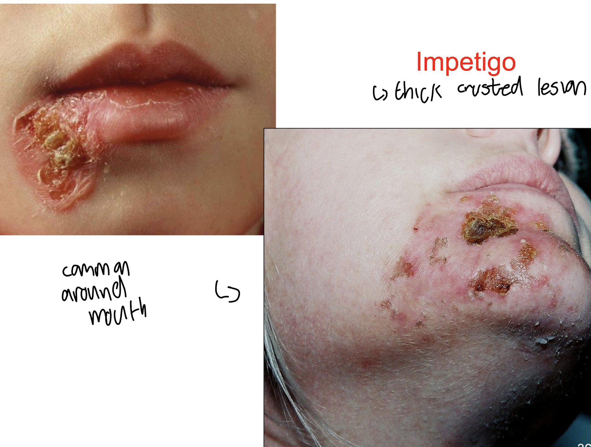 <p><strong>a highly contagious skin infection often around the mouth </strong>primarily affecting children<strong>, characterised by red sores that can rupture, ooze, and form a yellow-brown crust. </strong></p>