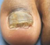 <p>nail thickening and subungal debris, usually from dermatophyte, can also be from molds, often preceded by tinea pedis (athletes foot)</p>