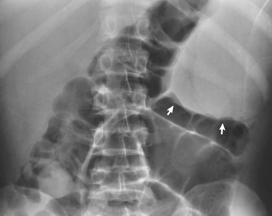 <p>KUB with leukemia can also represent as:</p><p>Most common non-skeletal radiographic appearance</p>