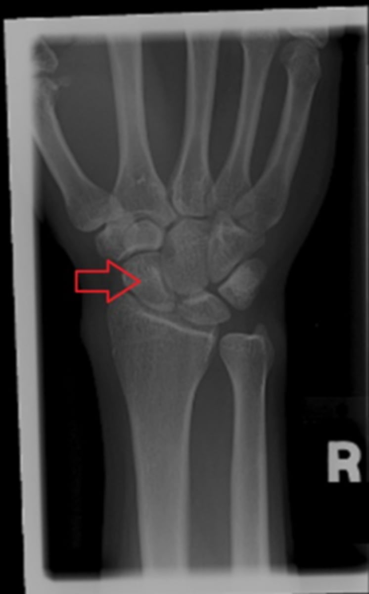 <p>on the given wrist image, the red arrow point to the...?</p><p>a. capitate</p><p>b. lunate</p><p>c. scaphoid</p><p>d. triquetrum</p>
