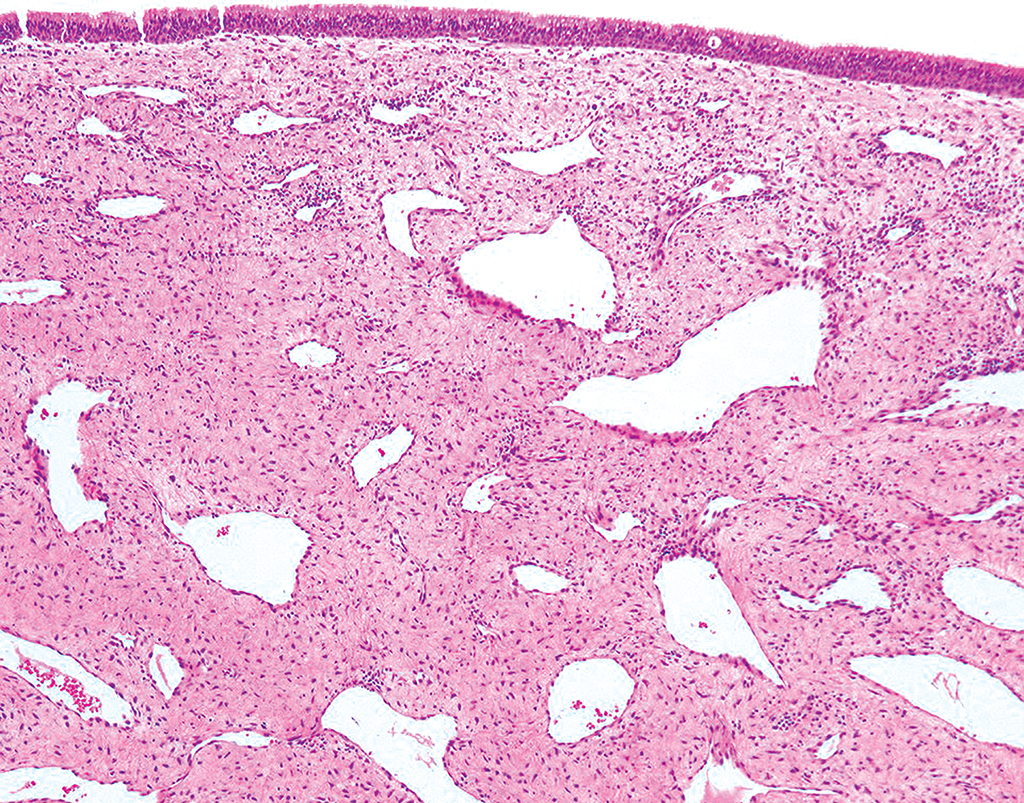 <p>Jeune garçon, masse hypervascularisée du nasopharynx postérieur</p><p>1) Diagnostic</p><p>2) Localisation et population</p><p>3) Histologie </p><p>4) IHC</p><p>5) moléculaire </p>