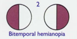 <p>bitemporal hemianopia</p>