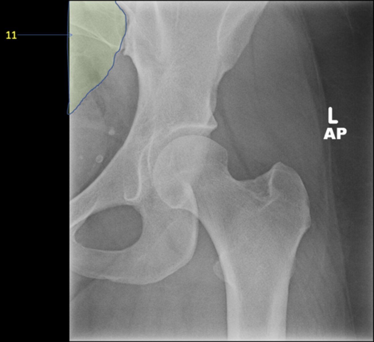 <p>ID 11 (bone)</p>
