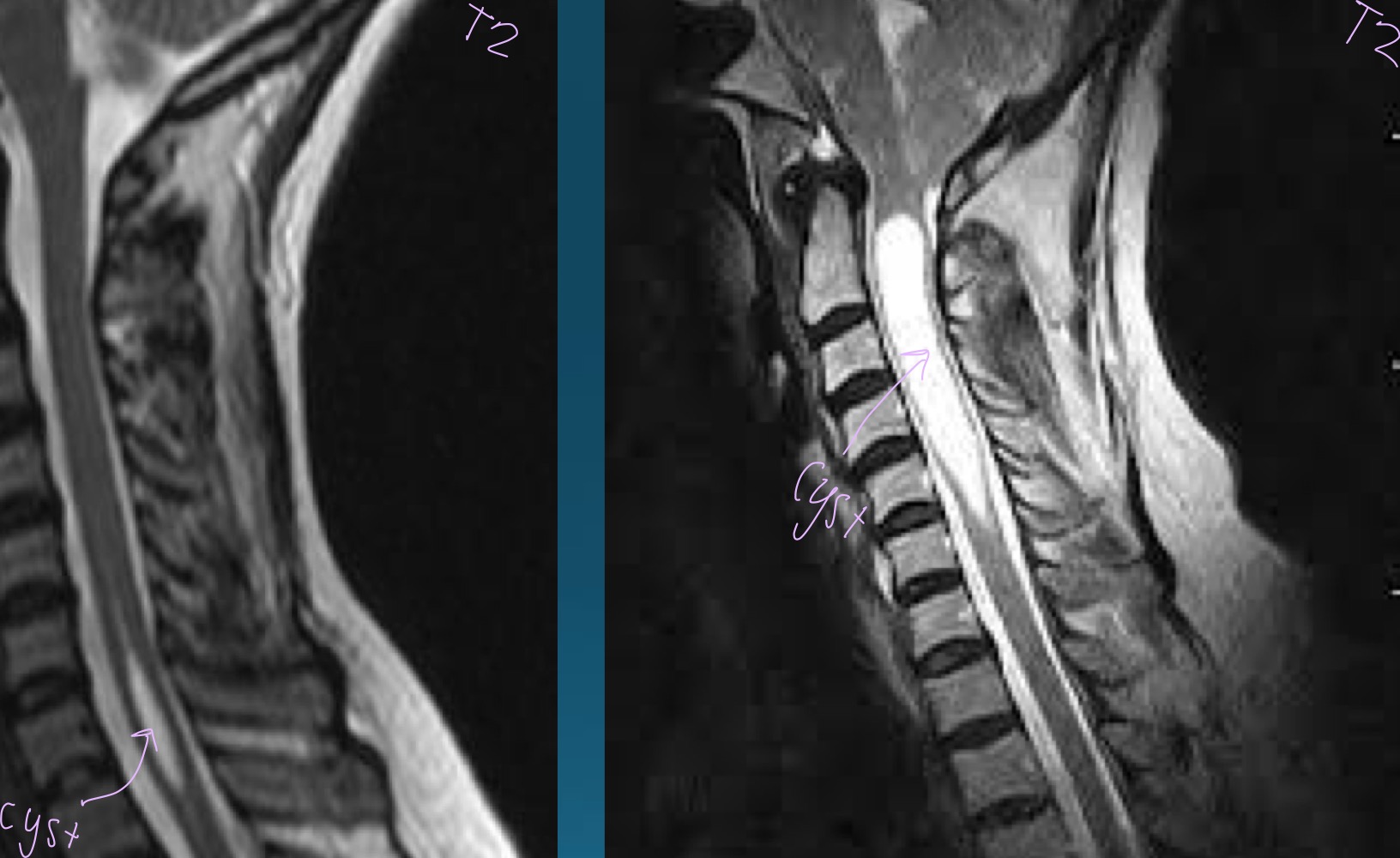 <p>what finding is in this image?</p>