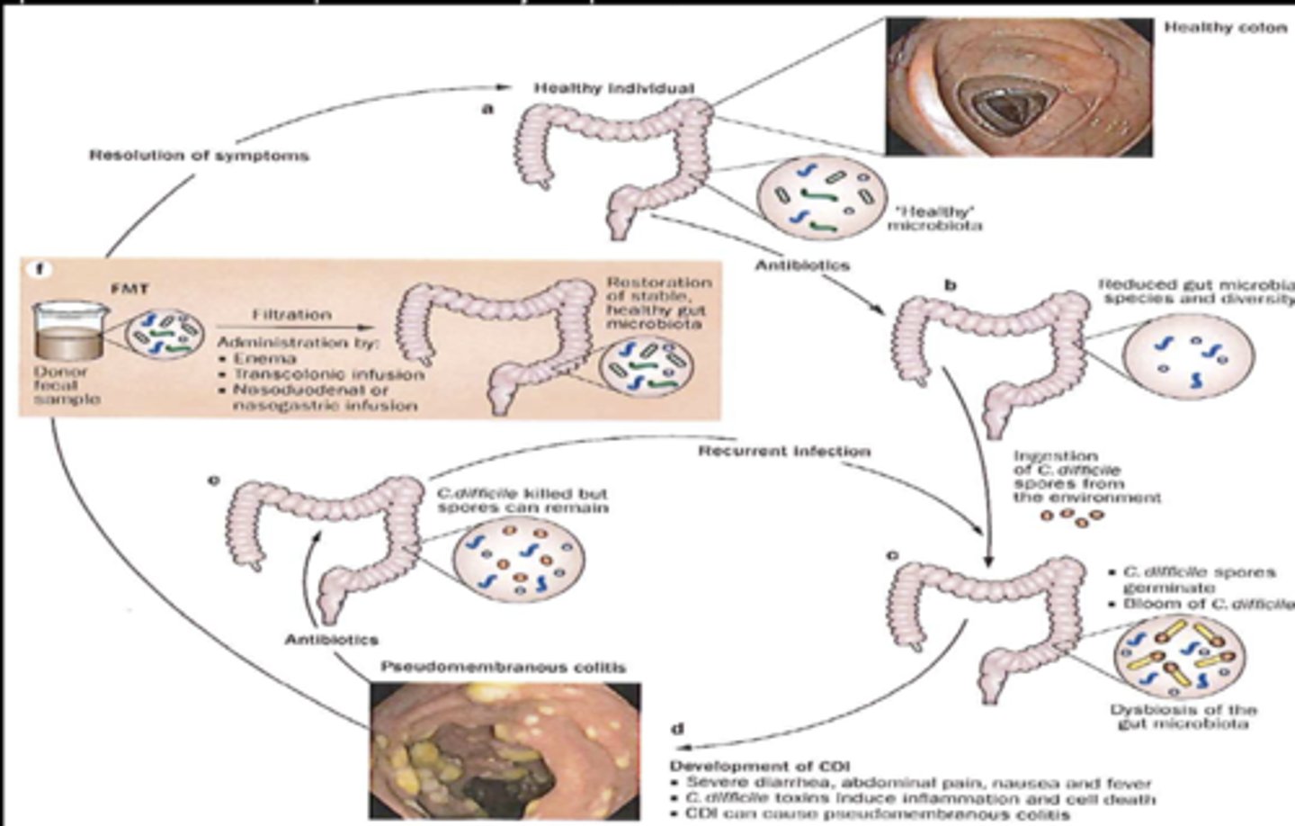 <p>Fecal Microbiota Transplantation</p>