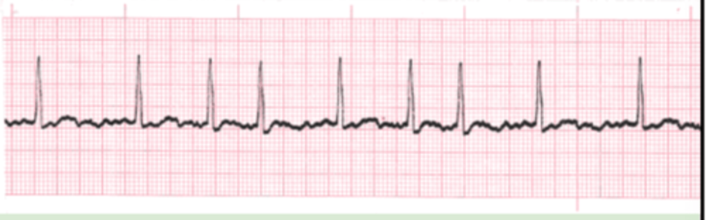 <p>Originate: atrial is fibrillating and not contributing to ventricular filling</p><p>QRS complex: narrow</p><p>P wave: none</p><p>Heart rate: variable</p><p>R-R intervals: irregular</p><p>Unsynchronized and chaotic</p>