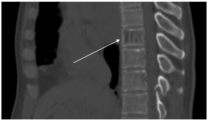 <p>This CT image, bone window, shows?</p>