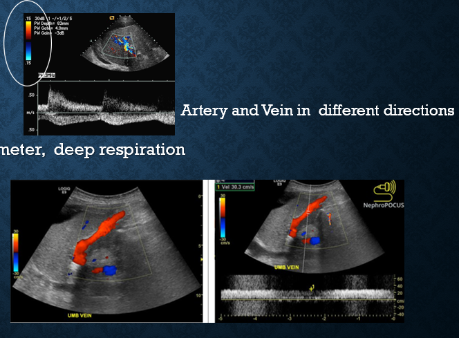 <ul><li><p>hepatofugal flow </p></li><li><p>portal vein diameter >13mm </p></li><li><p>decreased splenic vein flow </p></li><li><p>recanalized umbilical vein (originates from left portal vein) </p></li></ul><p></p>