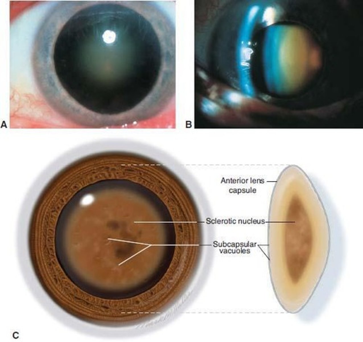 <p>A dense cloudiness that forms in the normally clear ocular lens, leading to visual loss when located on the visual axis.</p>