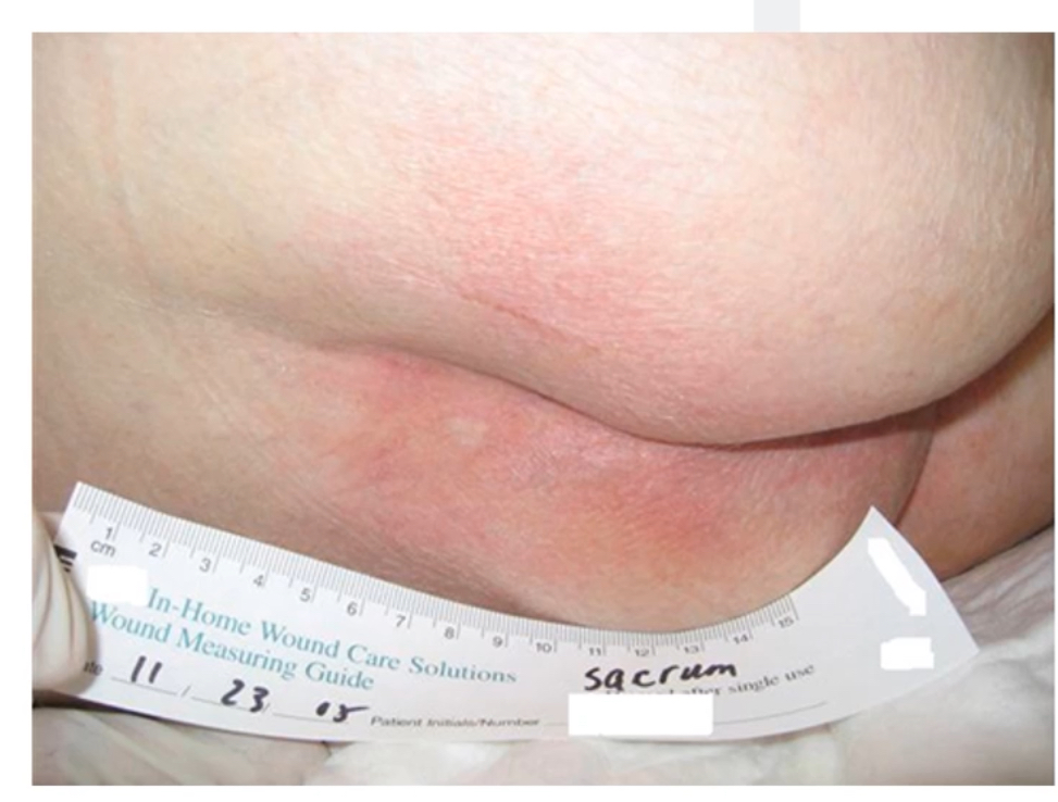 <p>Usually in elderly/pts with mobility issues who stay in the same place, tissue damaged occluded as no proper oxygen to the area</p>