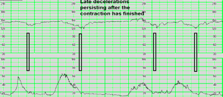 <p>- slowing or fhr during contraction, with the rate only returning to baseline 30 secs of more after contraction ended - <strong>biggest drop/decrease is after contraction ends</strong></p><p>- caused by utero-placental insufficiency</p><p>- sign of fetal distress or hypoxia</p><p>- gradual onset &gt; 30sec from onset to peak</p><p>- always take seriously - most serious one</p>