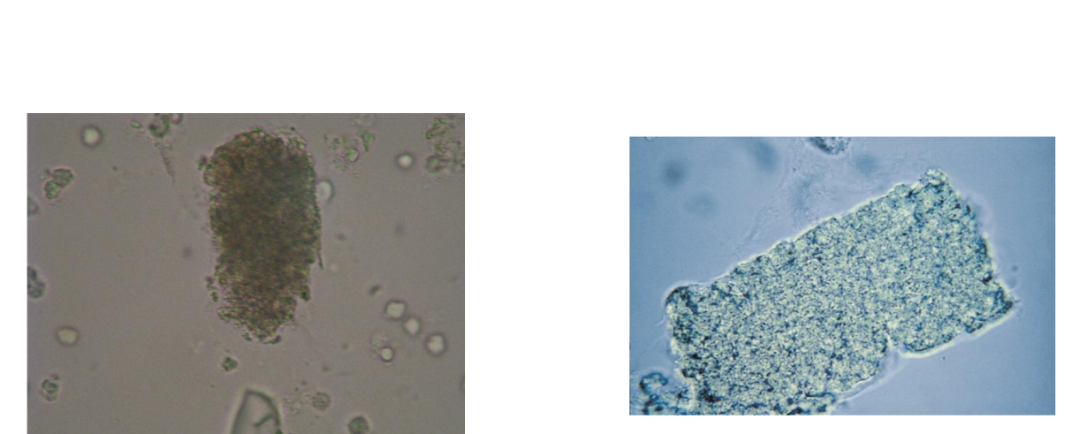 <p><span>Renal failure casts</span></p><p></p><p><span>Destruction and</span></p><p><span>widening</span></p><p><span>of the DCTs</span></p><p></p><p><span>Formation in the upper</span></p><p><span>collecting duct</span></p><p></p><p><span>All types of casts may be</span></p><p><span>broad</span></p><p></p><p><span>Most common are</span></p><p><span>granular and waxy</span></p><p></p><p><span>Bile stained from viral</span></p><p><span>hepatitis</span></p>